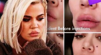 Khloe Kardashian Reveals Before-and-After Photos of Facial Fillers After Tumor Removal