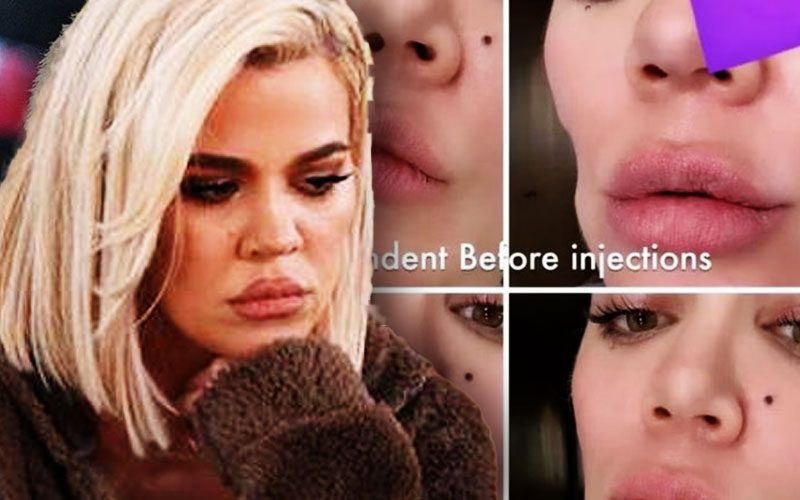 khloe-kardashian-reveals-before-and-after-photos-of-facial-fillers-after-tumor-removal-04